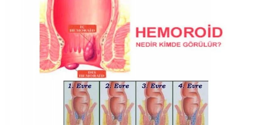 Hemoroit Nedir Nasıl Tedavi Edilir?