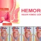 Hemoroit Nedir Nasıl Tedavi Edilir?