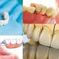 Protetik Diş Tedavisi Öncesi ve Sonrası